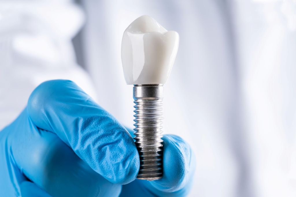 Tipuri de implanturi dentare: Ce soluții aleg clinicile moderne